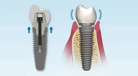 Винты для имплантов зубов: современные технологии и преимущества